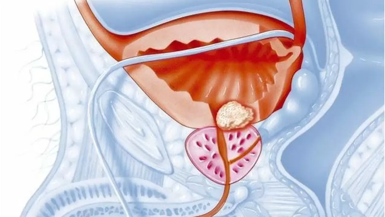 prostate disease in men